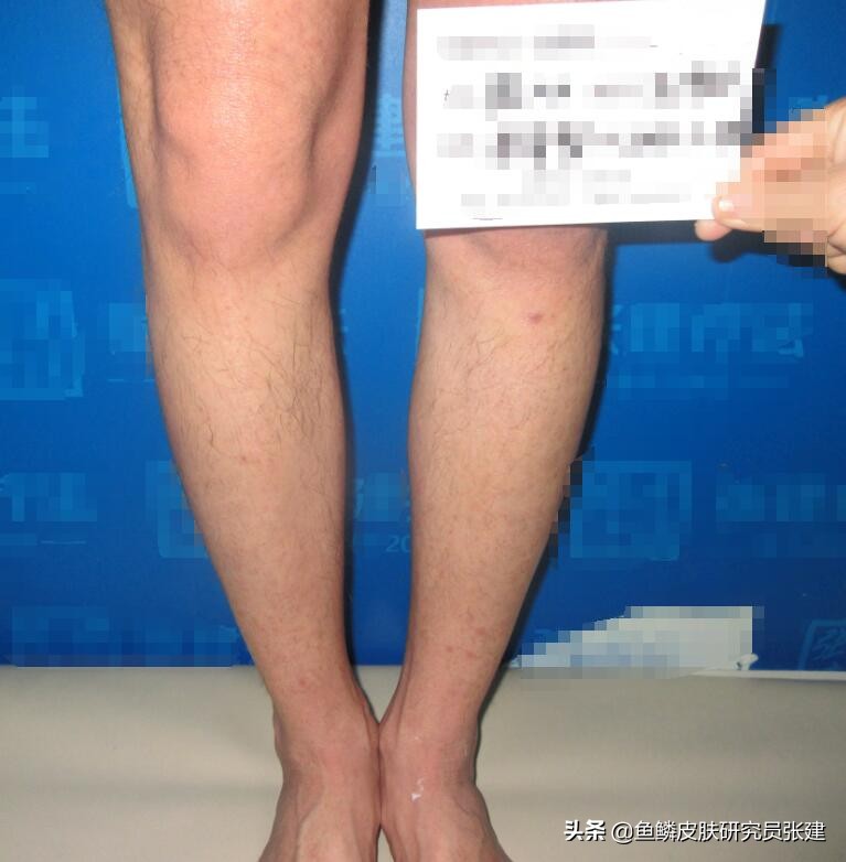 老公有鱼鳞病会遗传吗,老公有鱼鳞病15个月了还会有吗