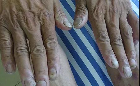 干货来啦！特殊部位的银屑病究竟应该如何护理？