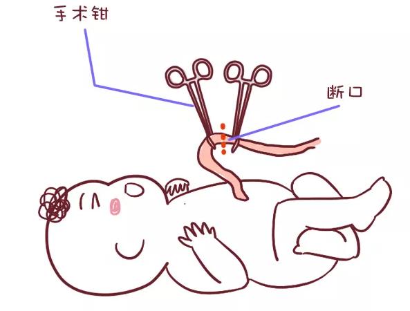 剖腹产手术后缝几层线,剖腹产把肚子刨开几层