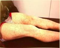 吃药身上起药疹怎么办还要吃吗,吃药一周后身上起疹子是药疹