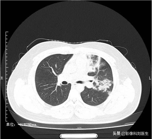 支气管肺炎x线影像,影像学肺炎与支气管炎的描述