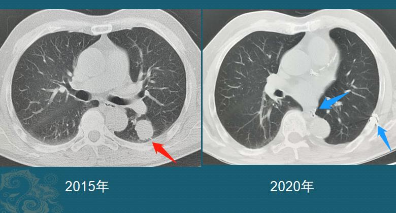 老人得了肺癌会转移吗,老人肺癌6年了