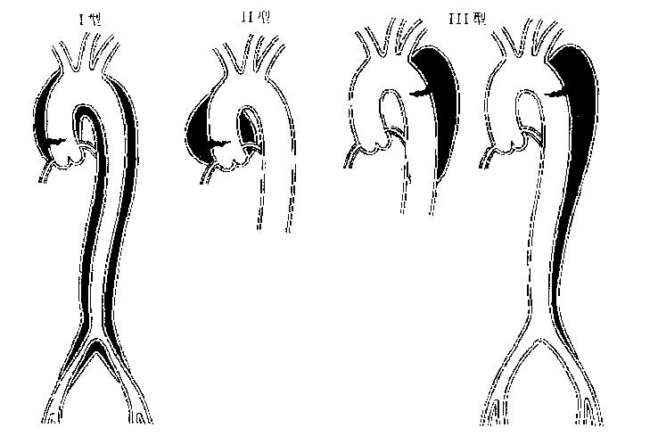 急性心肌梗死的做法,内科主治心肌梗死视频