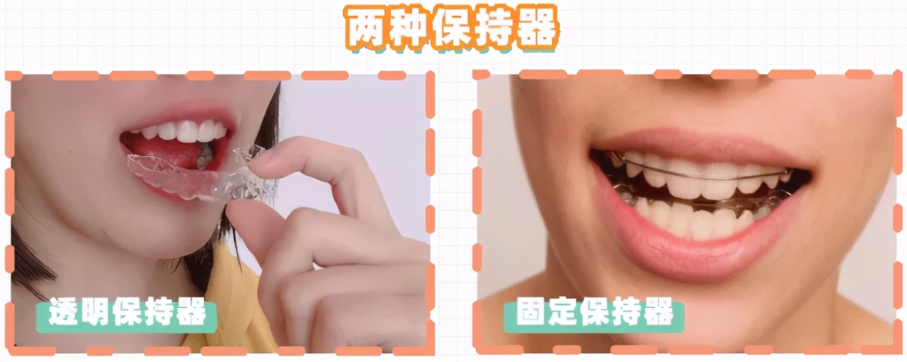 牙齿矫正的九大常见误区,牙齿矫正之七大误区