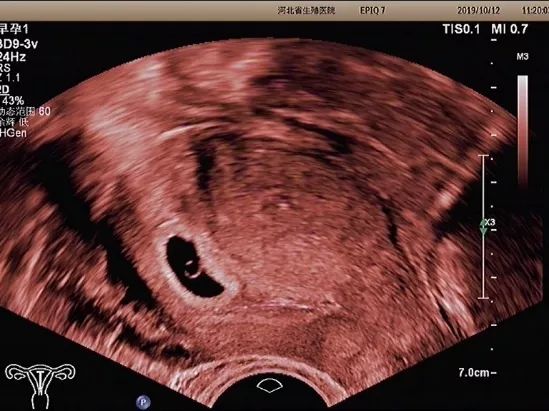 经阴超声检查会不会感染,阴式超声检查会影响胎儿吗