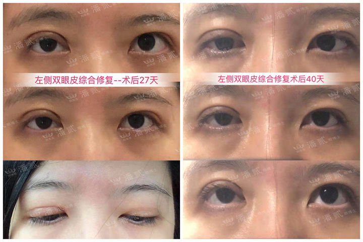 双眼皮手术后问题,双眼皮术后怎么才知道恢复好了没