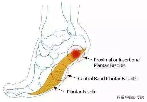 足底筋膜炎改善和解决的方法,足底筋膜炎的预防治疗和恢复