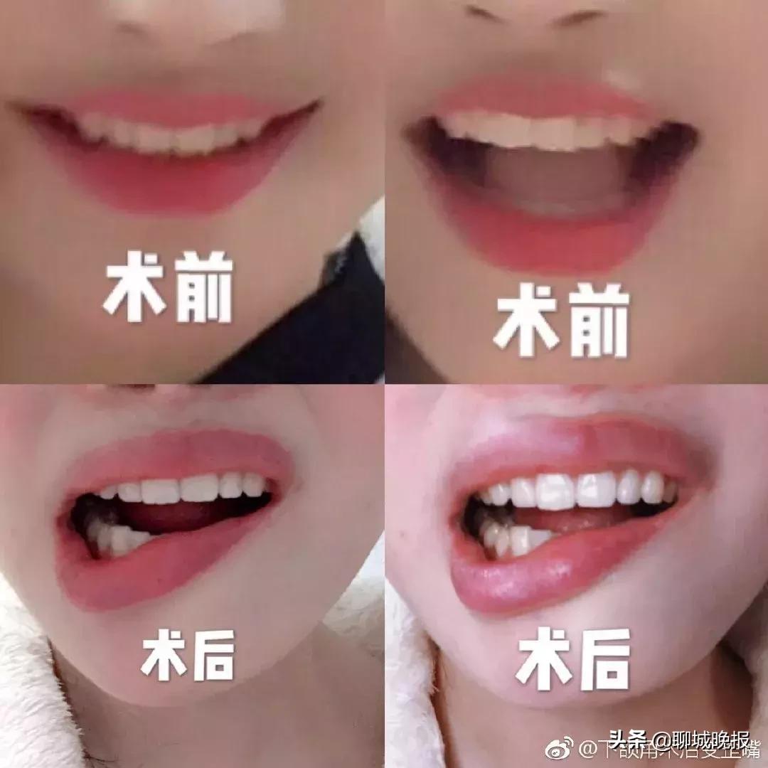 “毁了我一生！”25岁女孩整容成歪嘴，医院只赔5000元