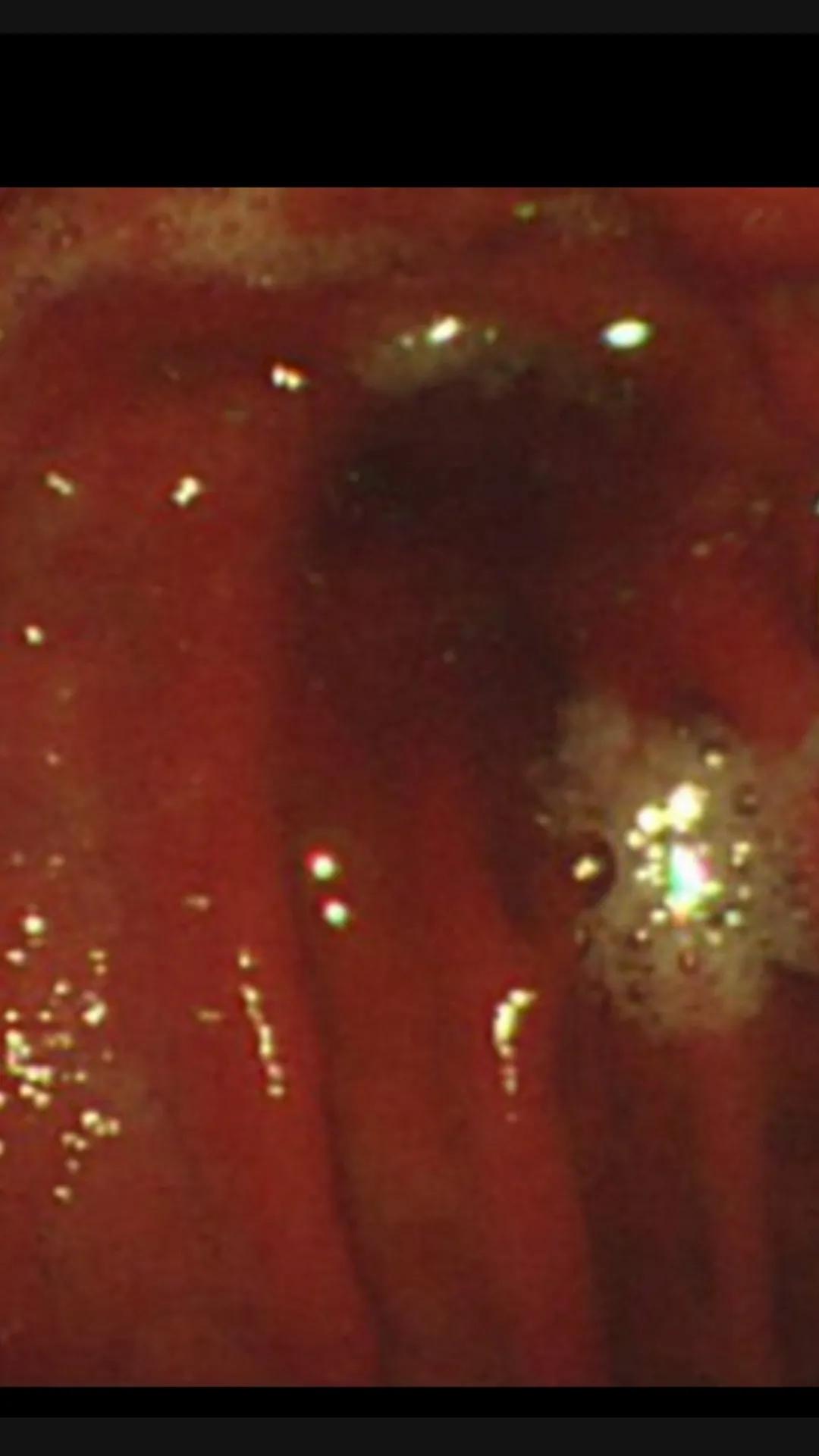 急性胃炎的症状及治疗方法,急性胃炎分类