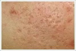 如何有效祛除痘印简单方法,怎么有效简单的祛除痘印的方法