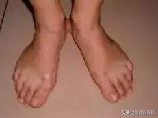 拇外翻平时走路需要注意哪些点,如何缓解拇外翻脚的痛