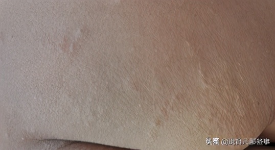 很恐怖的过敏图片,过敏发朋友圈的真实图片