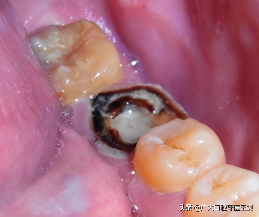 烂牙残根不拔的危害大吗,多的烂牙残根不拔的危害大吗
