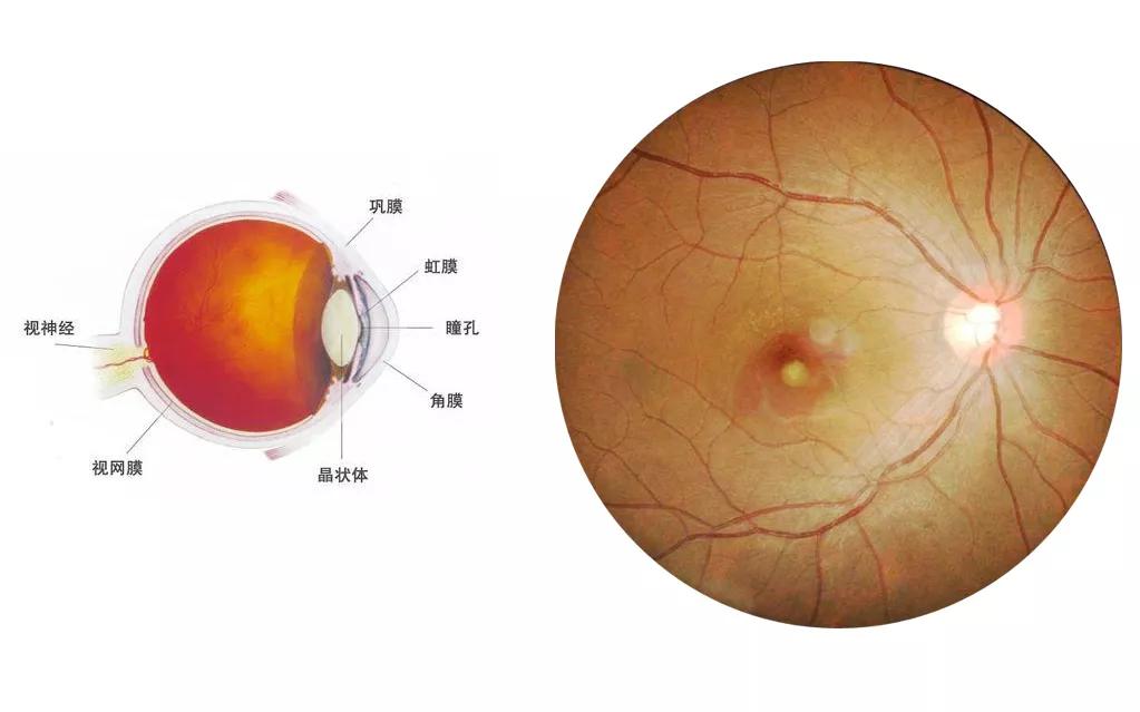 因糖尿病导致的失明怎么诊断,糖尿病眼瞎早期的症状是什么