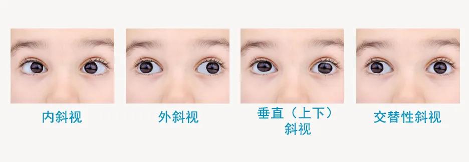儿童斜视健康宣教,斜视矫正训练方法视频