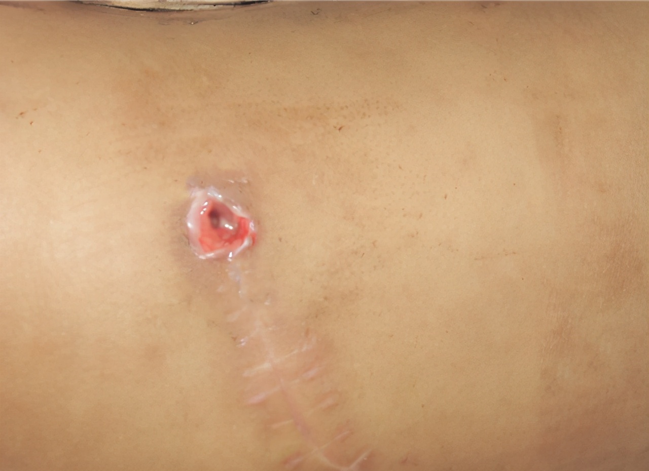 腰椎结核用哪种药比较好,腰椎结核的患者要注意什么