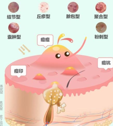 丘疹性痘痘肌肤怎么治疗,如何彻底根治丘疹型痘痘