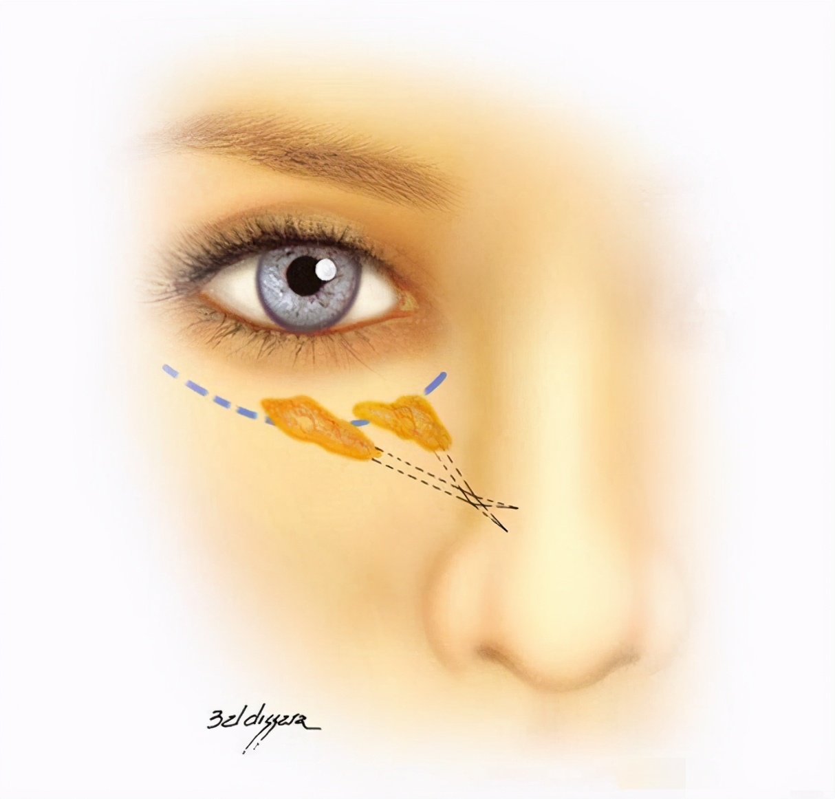 什么是眶隔脂肪释放？为什么很多医生都建议用这个方法去眼袋？