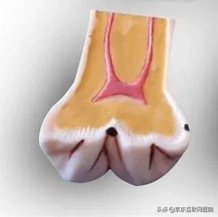 牙齿上面有黑线补牙怎么弄,牙齿有严重黑线怎么补牙