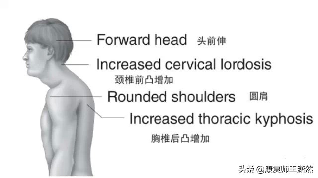上交叉综合征多久能改善,上交叉综合征康复训练