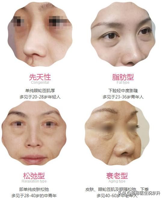 眼袋困扰多年不要急试试这个方法,消除眼袋也有省钱又省时的好方法