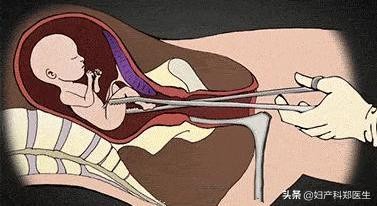 怀孕5个月可以选择人流吗,发现怀孕了什么时候人流最合适