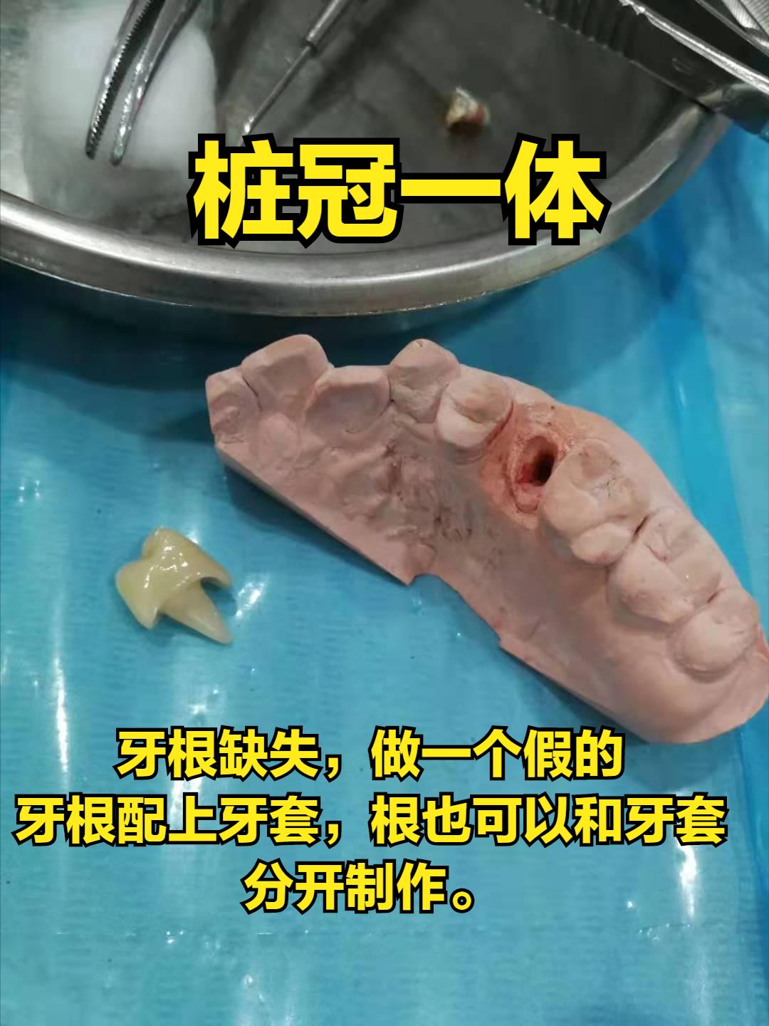 假牙套怎么种植牙,戴的假牙套与全瓷牙的感觉