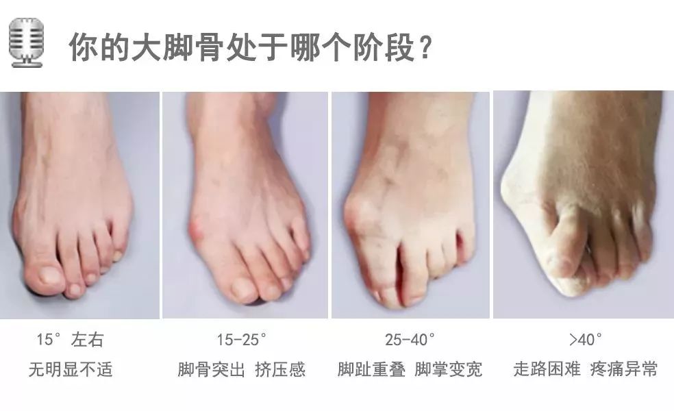 脚趾超级痛,轻度脚趾外翻如何矫正