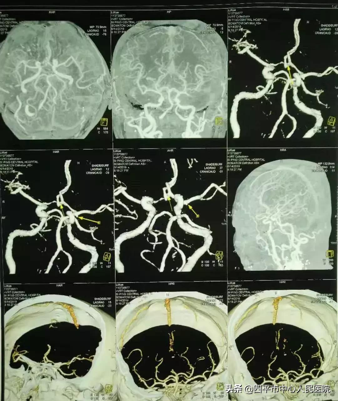 精准排雷再现新高—神经外科在6月份成功救治6例颅内动脉瘤患者
