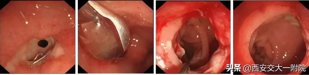告别胀气堵塞,告别各种肠胃困扰