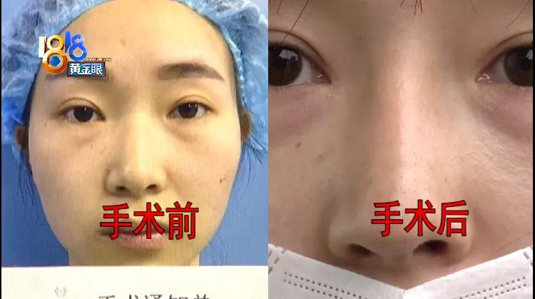 鼻子突然变暗变红,想要鼻子变高的方法