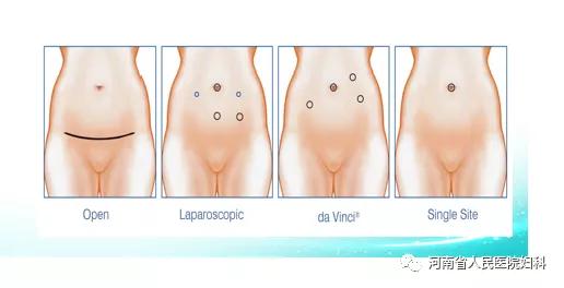 揭秘卵巢癌系列三