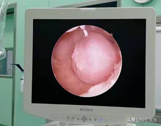 子宫内膜厚月经量大贫血怎么治疗,子宫内膜增厚月经量多导致贫血