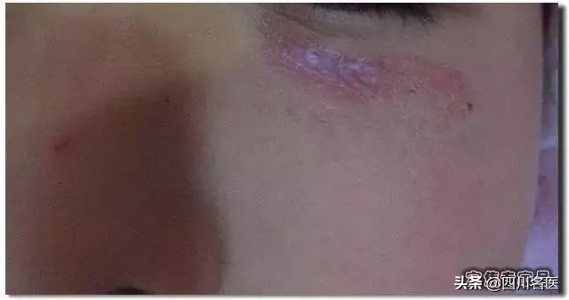 宝宝脸上有疤可以涂芦荟胶吗,小孩脸上有疤痕要抹多久的芦荟胶