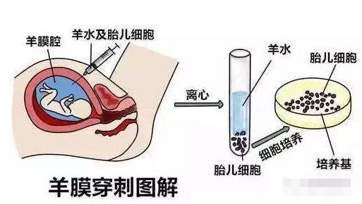 唐筛什么情况下需要做羊水穿刺,唐筛过了有必要做羊水穿刺吗