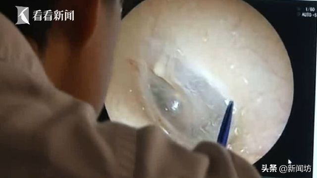 女孩耳朵总是沙沙作响，一查竟是因为“吸猫”