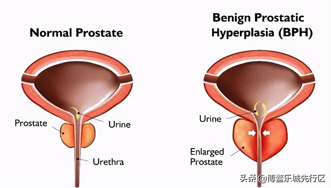 特别频繁上厕所小便中医辨证治疗,经常起夜上厕所如何改善