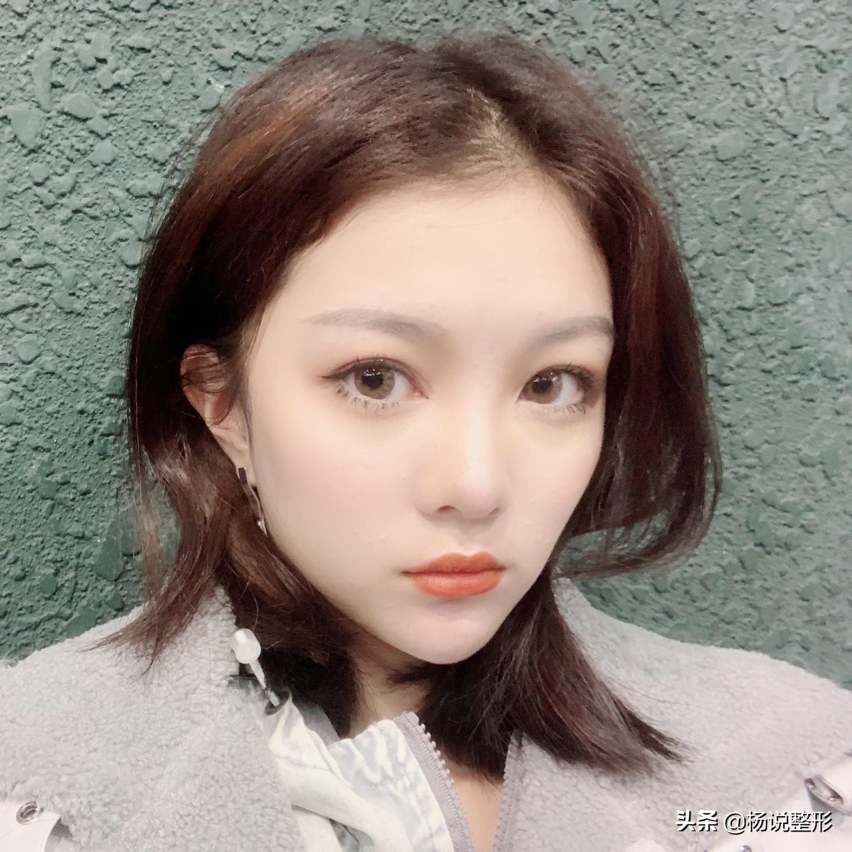 28岁做线雕提升脸部好不好,28岁女人做线雕现状