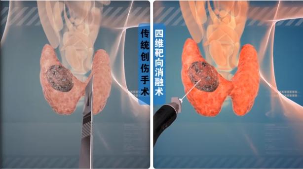 真实案例：警惕建筑材料中致病因素！患者3.9cm甲状腺结节已融合