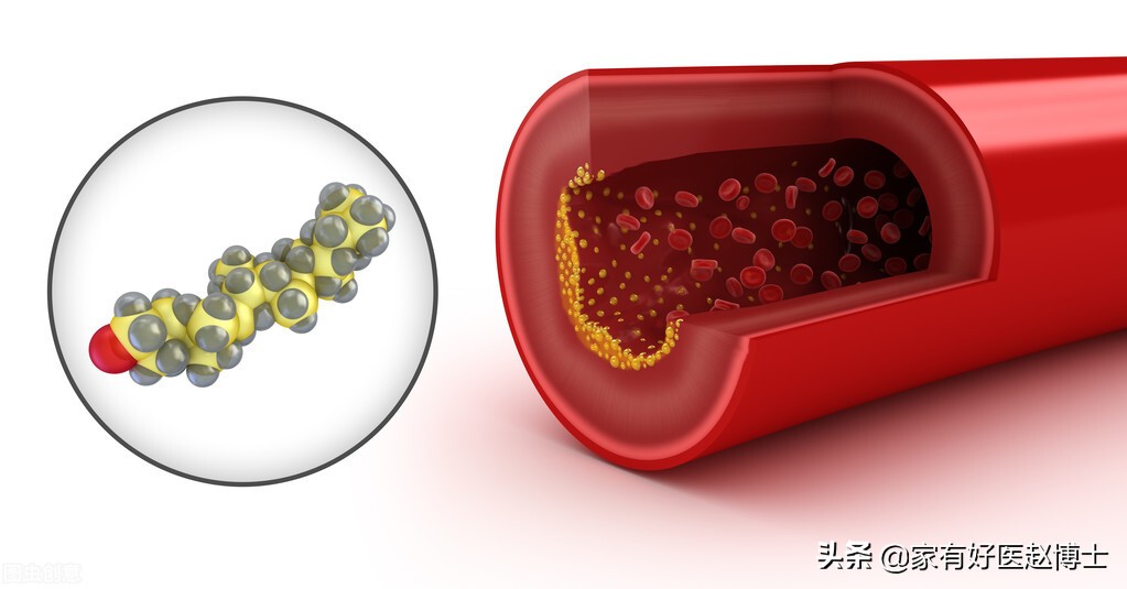 到底能不能软化血管和逆转斑块,使血管斑块变小要用多大剂量他汀