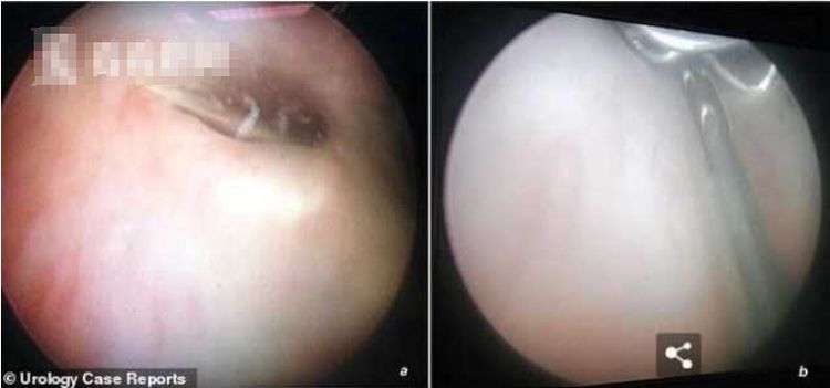 14岁男生把9厘米缝衣针插入尿道,痛苦三天去就医,网友:爽吗?