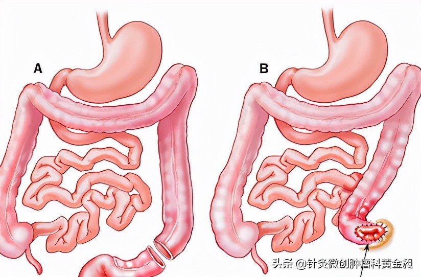 直肠术后的难言之隐,直肠癌脱出肛外的症状