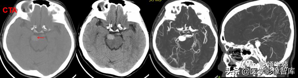 鞍区肿瘤做什么检查得出来,鞍区肿瘤的影像学鉴别