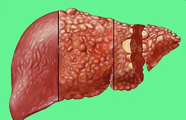 肝有点异常要注意什么,肝有点硬怎么治