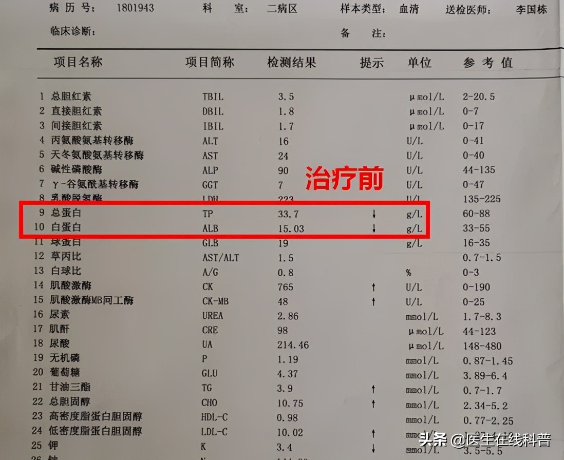 肾病综合征停药一个月又出现水肿,肾病综合征总复发心里恐慌怎么办