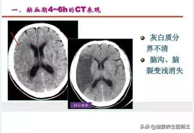 生命健康有哪些方面,临床症状脑血栓形成