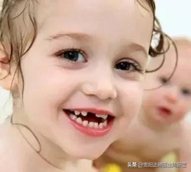 12岁前必须解决的错颌畸形,孩子十二岁牙畸形怎么办