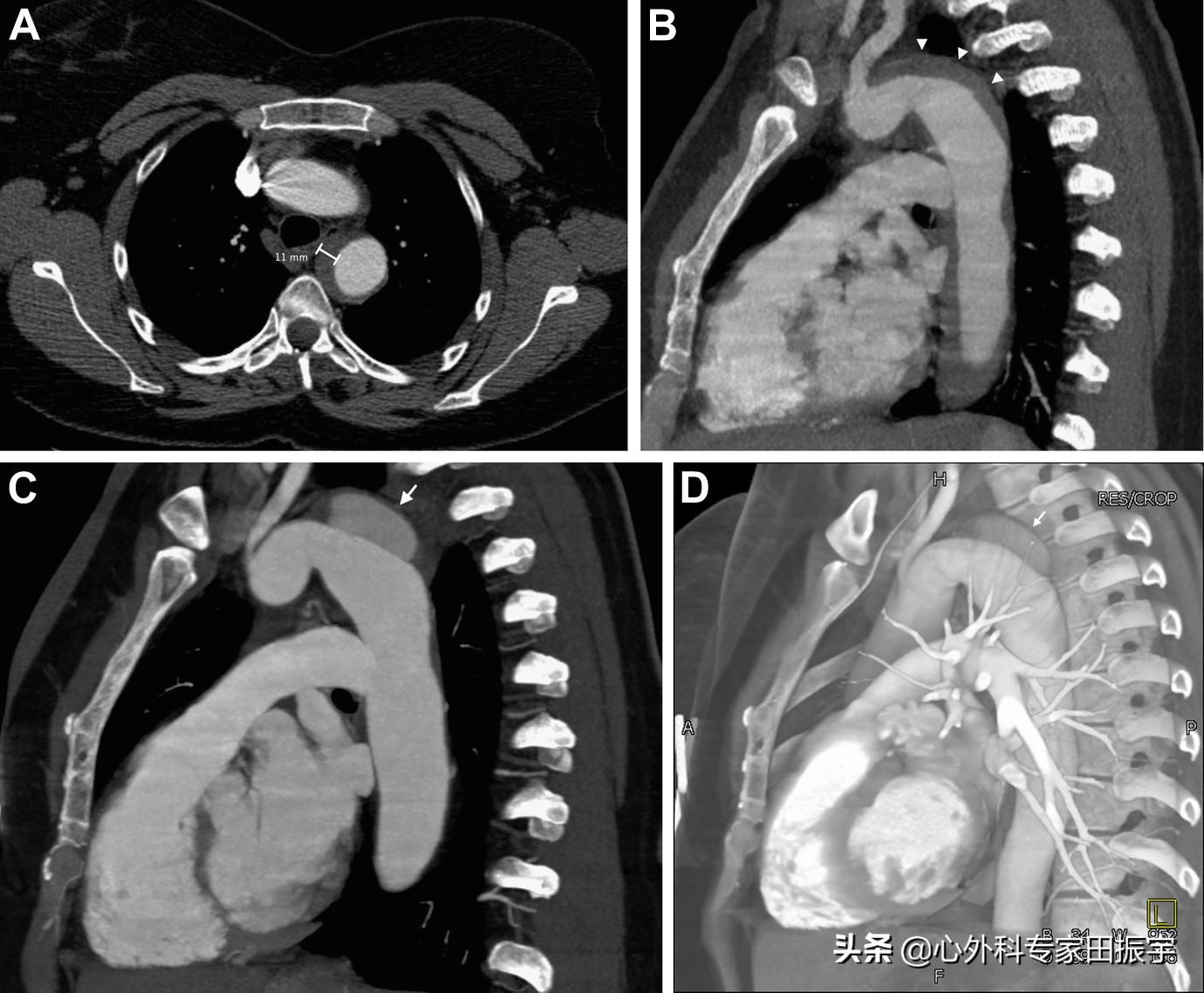 主动脉血肿危险期,高危脑动脉瘤破裂出血