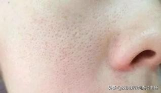 反复出油长痘毛孔堵塞怎么调理,t区出油毛孔大脸颊干是什么肤质