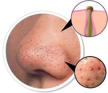 小气泡清洁推荐去黑头收缩毛孔,小气泡去黑头会让毛孔越来越大吗